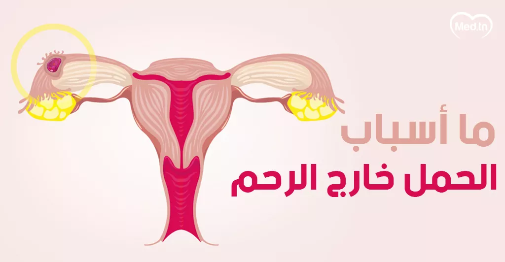 ما أسباب الحمل خارج الرحم